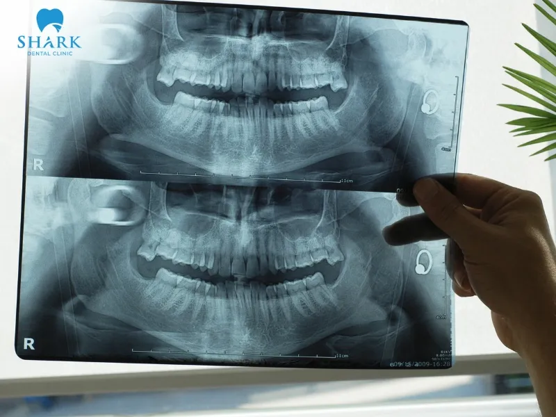 Dentists may recommend that patients undergo dental X-rays every 6–12 months, depending on clinical needs