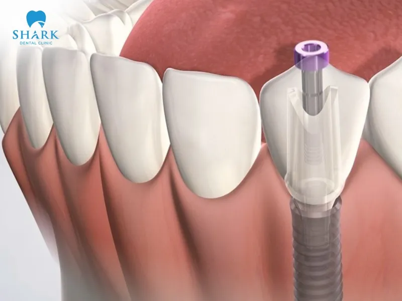 The procedure of dental implant placement is fairly simple and helps optimize treatment costs