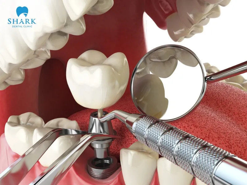 The average lifespan of dental implant treatment can reach up to 25 years or even last a lifetime with proper care