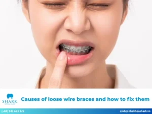 Many people wonder, "Do braces hurt?" While braces can cause soreness and discomfort, these feelings usually decrease over time. Typically, patients experience mild sensitivity, tightness, and discomfort around the gums. Once the pressure stabilizes and the brackets are properly adjusted, these sensations improve quickly and often disappear completely. Braces can cause soreness and discomfort, but they will gradually subside after a period of time When does braces pain usually start? During orthodontic treatment, patients often feel discomfort at various stages: Placing separators: About 6 to 8 hours after separators are placed, patients may experience dull soreness, especially while eating, chewing, or consuming hot or cold foods. This discomfort usually subsides after about three days without the need for intervention. Attaching orthodontic appliances: When the dentist places brackets and archwires on the teeth, many individuals feel dull pain, tightness, and sensitivity throughout the jaw. In the early stage after appliance placement, patients may also experience irritation and inconvenience in daily activities. Tightening the archwire: The tightening stage can cause mild sensitivity and discomfort. However, this pain is generally light, as the jawbone and teeth gradually adapt to the orthodontic pressure. Adjusting archwire tension: During follow-up visits, adjusting the wire tension or replacing elastics may lead to temporary soreness. This sensation is usually mild and does not significantly interfere with daily eating or activities. Removing braces: After completing orthodontic treatment, some people may experience slight discomfort when the braces are removed. The sensation and intensity of pain may vary at different stages of treatment Why do braces cause pain and pressure? If you are asking, "Do braces hurt?" the discomfort can occur for several reasons: At the beginning of treatment, patients are not accustomed to having orthodontic appliances in their mouths. The nervous system and periodontal ligaments react to the orthodontic appliances as the teeth begin to move. Brackets and archwires may rub against the soft tissues inside the mouth, causing gum irritation and soreness. Improper orthodontic techniques or uneven pressure from the dentist may also lead to pain during treatment. In some cases, discomfort may result from low-quality dental materials that can oxidize or become damaged during orthodontic treatment. Braces-related pain may result from orthodontic techniques or brackets rubbing against the soft tissues How long does braces pain last? Braces-related pain typically lasts about 5 to 7 days. In the initial days, you may experience soreness, tooth sensitivity, irritation, and difficulty with daily activities. The intensity of the pain gradually decreases and eventually resolves, allowing you to eat and communicate normally. However, if the pain does not improve after 7 days or becomes more severe, you should contact your dentist. The dentist will examine the situation, determine the cause of the prolonged pain, and provide appropriate and safe solutions. Pain caused by braces usually lasts about 5–7 days Common types of braces pain and discomfort While wearing orthodontic appliances, patients may experience different types of discomfort, including: Braces pain during eating and chewing During meals, food may become trapped around the brackets or archwires. This can cause irritation and discomfort, as well as tooth sensitivity and soreness while chewing. Braces pain from wires or brackets To move misaligned teeth into the desired positions, the dentist applies appropriate pressure to the archwire. However, if the pressure is too strong, it can cause soreness and discomfort for the patient. Strong tightening force can cause soreness during the braces process How to relieve braces pain at home If you experience tooth pain after an orthodontic adjustment, consider the following pain-relief measures: Rinse with warm salt water: Salt water has antibacterial properties that help prevent infection and soothe mouth sores caused by brackets rubbing against soft tissues. After getting braces, rinse with salt water 2–3 times a day. Apply a cold compress: Soreness and discomfort after each tightening adjustment can interfere with daily activities. Applying a cold compress can help reduce numbness and swelling in the gums. Use a warm compress: A warm compress can improve blood circulation and alleviate tooth soreness and sensitivity during orthodontic treatment. Massage the gum area: Spend 3–5 minutes each day gently massaging the gum area. This helps improve blood circulation and effectively relieve tooth pain. Use orthodontic wax: Using dental wax is a common way to relieve pain associated with braces. Orthodontic wax safely covers sharp bracket edges, reducing friction against the soft tissues in the mouth. Topical anesthetic: If the pain from braces becomes excessive, you may consider using a numbing gel. However, consult your dentist to choose the appropriate anesthetic and follow the recommended dosage. Pain relievers: Your dentist may prescribe pain medication when necessary. Make sure to follow their instructions strictly and avoid self-medicating or adjusting the dosage, as this can affect tooth movement during treatment.