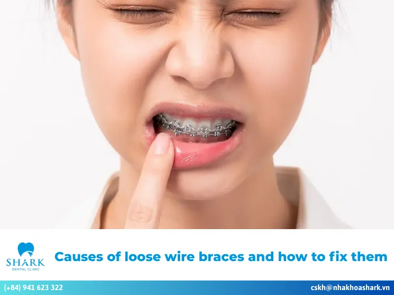 Many people wonder, "Do braces hurt?" While braces can cause soreness and discomfort, these feelings usually decrease over time. Typically, patients experience mild sensitivity, tightness, and discomfort around the gums. Once the pressure stabilizes and the brackets are properly adjusted, these sensations improve quickly and often disappear completely. Braces can cause soreness and discomfort, but they will gradually subside after a period of time When does braces pain usually start? During orthodontic treatment, patients often feel discomfort at various stages: Placing separators: About 6 to 8 hours after separators are placed, patients may experience dull soreness, especially while eating, chewing, or consuming hot or cold foods. This discomfort usually subsides after about three days without the need for intervention. Attaching orthodontic appliances: When the dentist places brackets and archwires on the teeth, many individuals feel dull pain, tightness, and sensitivity throughout the jaw. In the early stage after appliance placement, patients may also experience irritation and inconvenience in daily activities. Tightening the archwire: The tightening stage can cause mild sensitivity and discomfort. However, this pain is generally light, as the jawbone and teeth gradually adapt to the orthodontic pressure. Adjusting archwire tension: During follow-up visits, adjusting the wire tension or replacing elastics may lead to temporary soreness. This sensation is usually mild and does not significantly interfere with daily eating or activities. Removing braces: After completing orthodontic treatment, some people may experience slight discomfort when the braces are removed. The sensation and intensity of pain may vary at different stages of treatment Why do braces cause pain and pressure? If you are asking, "Do braces hurt?" the discomfort can occur for several reasons: At the beginning of treatment, patients are not accustomed to having orthodontic appliances in their mouths. The nervous system and periodontal ligaments react to the orthodontic appliances as the teeth begin to move. Brackets and archwires may rub against the soft tissues inside the mouth, causing gum irritation and soreness. Improper orthodontic techniques or uneven pressure from the dentist may also lead to pain during treatment. In some cases, discomfort may result from low-quality dental materials that can oxidize or become damaged during orthodontic treatment. Braces-related pain may result from orthodontic techniques or brackets rubbing against the soft tissues How long does braces pain last? Braces-related pain typically lasts about 5 to 7 days. In the initial days, you may experience soreness, tooth sensitivity, irritation, and difficulty with daily activities. The intensity of the pain gradually decreases and eventually resolves, allowing you to eat and communicate normally. However, if the pain does not improve after 7 days or becomes more severe, you should contact your dentist. The dentist will examine the situation, determine the cause of the prolonged pain, and provide appropriate and safe solutions. Pain caused by braces usually lasts about 5–7 days Common types of braces pain and discomfort While wearing orthodontic appliances, patients may experience different types of discomfort, including: Braces pain during eating and chewing During meals, food may become trapped around the brackets or archwires. This can cause irritation and discomfort, as well as tooth sensitivity and soreness while chewing. Braces pain from wires or brackets To move misaligned teeth into the desired positions, the dentist applies appropriate pressure to the archwire. However, if the pressure is too strong, it can cause soreness and discomfort for the patient. Strong tightening force can cause soreness during the braces process How to relieve braces pain at home If you experience tooth pain after an orthodontic adjustment, consider the following pain-relief measures: Rinse with warm salt water: Salt water has antibacterial properties that help prevent infection and soothe mouth sores caused by brackets rubbing against soft tissues. After getting braces, rinse with salt water 2–3 times a day. Apply a cold compress: Soreness and discomfort after each tightening adjustment can interfere with daily activities. Applying a cold compress can help reduce numbness and swelling in the gums. Use a warm compress: A warm compress can improve blood circulation and alleviate tooth soreness and sensitivity during orthodontic treatment. Massage the gum area: Spend 3–5 minutes each day gently massaging the gum area. This helps improve blood circulation and effectively relieve tooth pain. Use orthodontic wax: Using dental wax is a common way to relieve pain associated with braces. Orthodontic wax safely covers sharp bracket edges, reducing friction against the soft tissues in the mouth. Topical anesthetic: If the pain from braces becomes excessive, you may consider using a numbing gel. However, consult your dentist to choose the appropriate anesthetic and follow the recommended dosage. Pain relievers: Your dentist may prescribe pain medication when necessary. Make sure to follow their instructions strictly and avoid self-medicating or adjusting the dosage, as this can affect tooth movement during treatment.