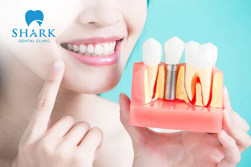 Dental implants after extraction need to be determined based on many factors and the professional evaluation of the dentist