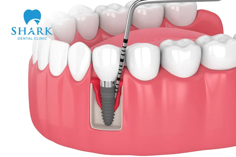 Successful dental implant placement depends on several different factors that must be carefully considered