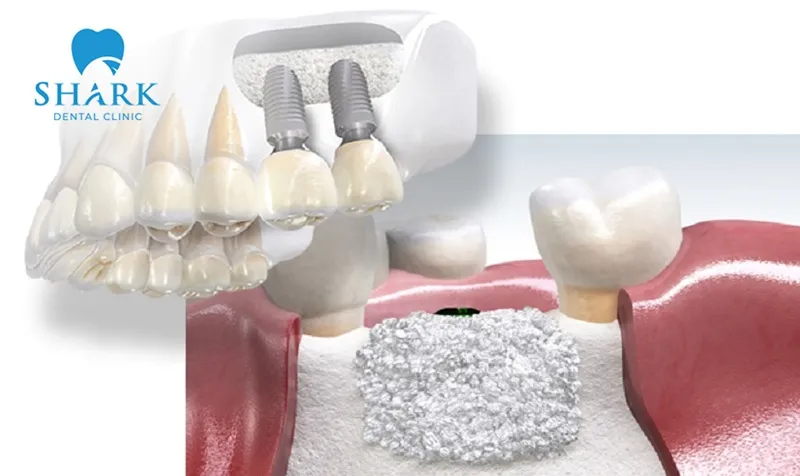 A comprehensive health check and an evaluation of jawbone condition are necessary before dental implant placement can be performed