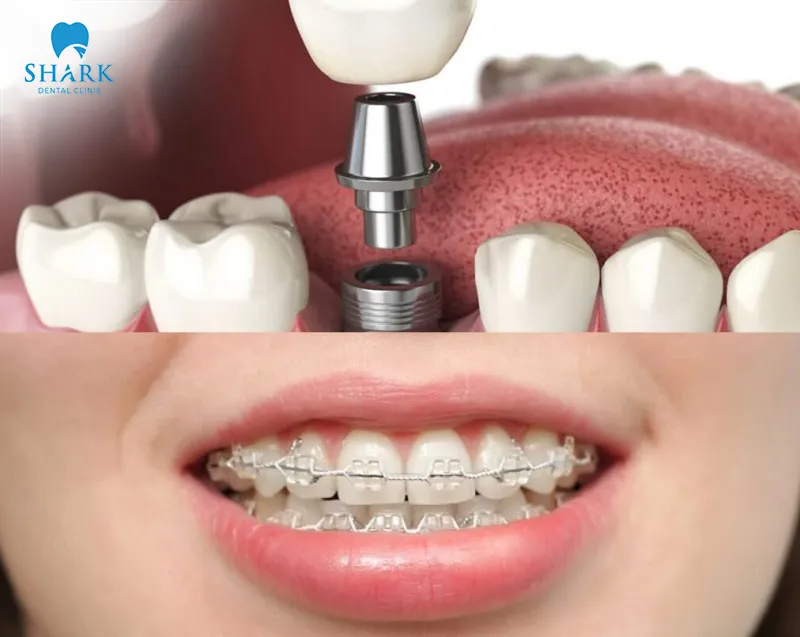 After dental implant placement, it is still possible to get braces as usual