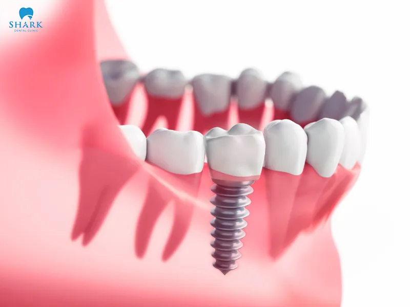 Getting braces after dental implant placement depends on factors such as jawbone density, the dentist’s expertise, and the treatment techniques applied