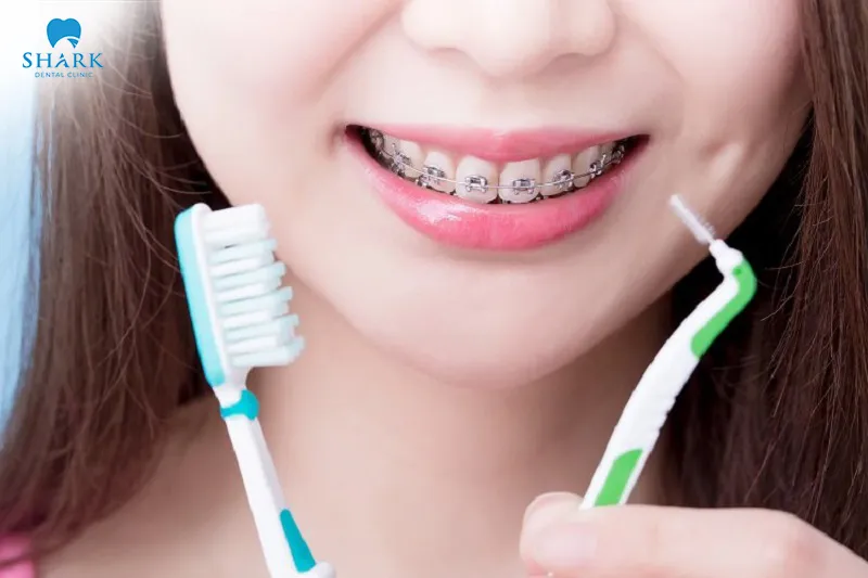 Pay close attention to proper care and oral hygiene after getting braces to ensure safe treatment and achieve stable results more quickly