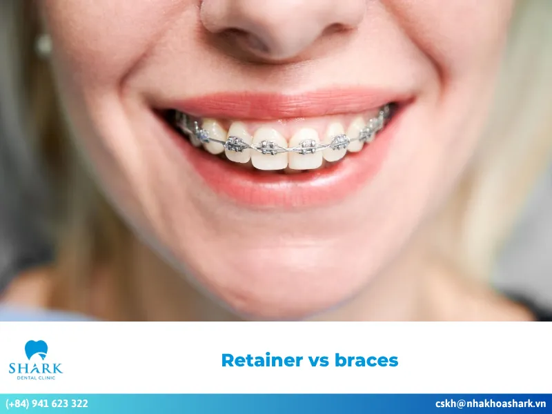 Retainer vs braces