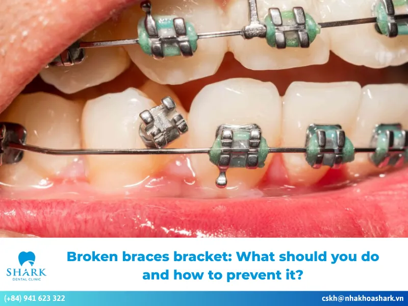 Broken braces bracket: What should you do and how to prevent it?