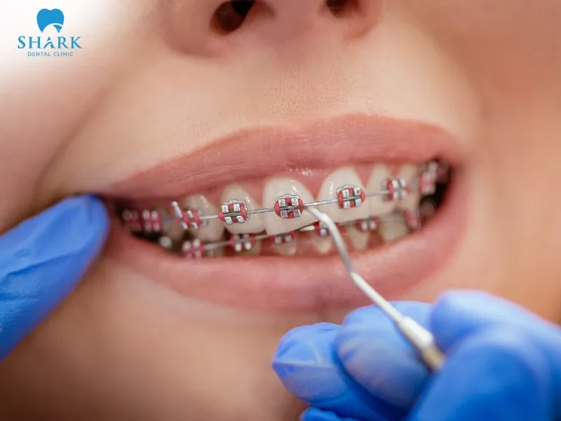 On average, it takes about 6–12 months for gaps between teeth to be noticeably closed