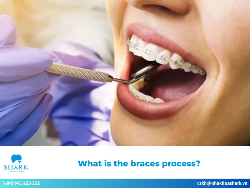 What is the braces process?
