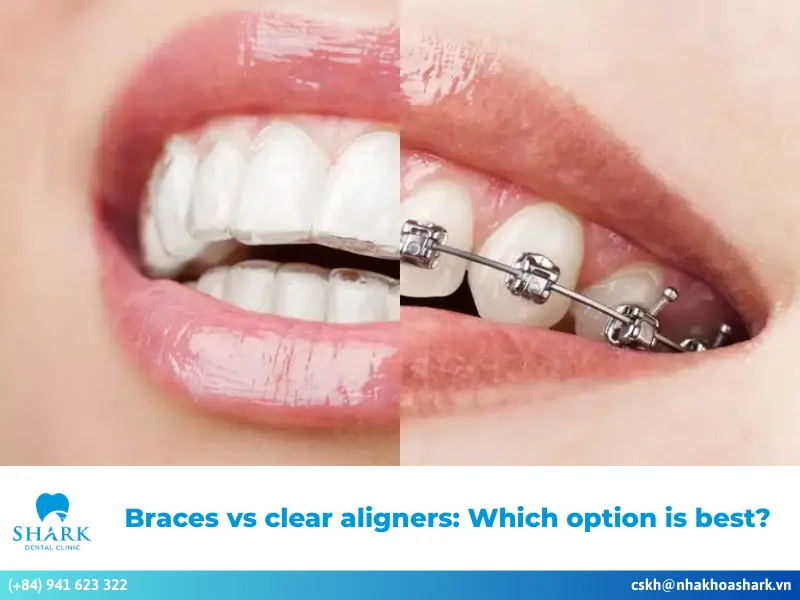 Braces vs clear aligners: Which option is best?