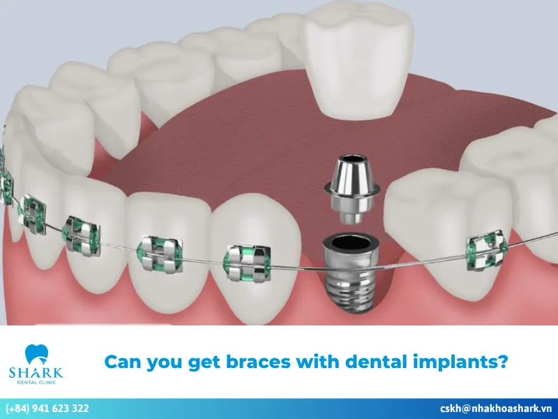 Can you get braces with dental implants?