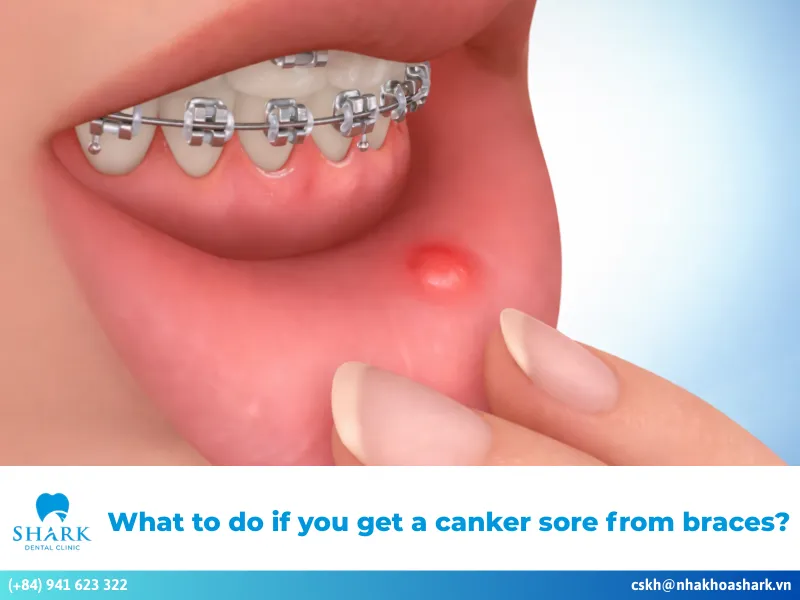 Canker sore from braces