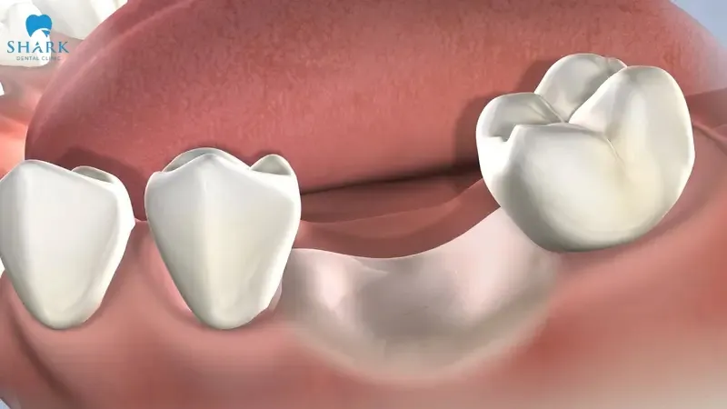 The white stuff after tooth extraction may form as a result of blood clot development