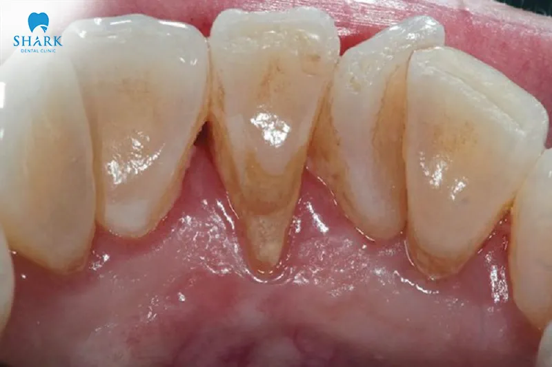 Gum recession can be caused by various factors, including oral care habits and individual biological conditions