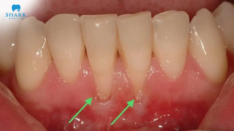 Veneers only improve the surface appearance of teeth and cannot treat or reverse gum recession