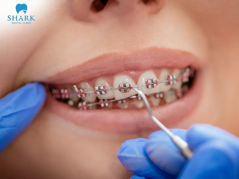 When the archwire becomes loose, the dentist will assess the condition and tighten it if necessary