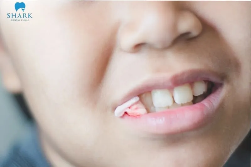 In addition to understanding how long to leave gauze in after tooth extraction, you should also know the correct way to place and bite on the gauze to make the process easier and more effective