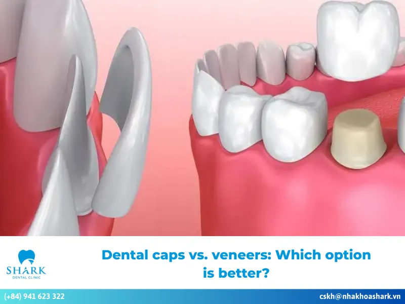 Dental caps vs. veneers: Which option is better?