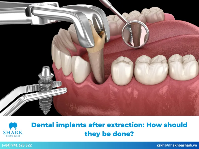 Dental implants after extraction