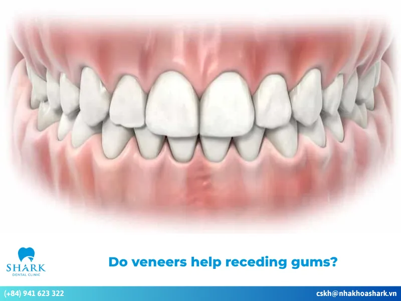 Do veneers help receding gums