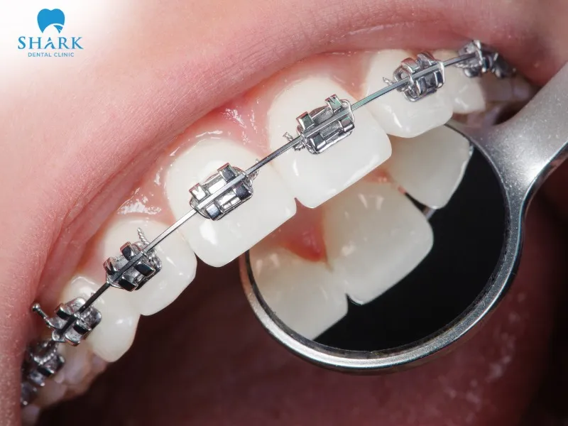 A broken braces bracket can result from brushing too hard, trauma, or impact