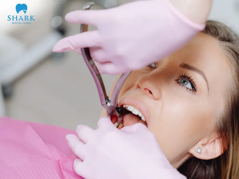 Depending on the specific condition, the dentist will provide appropriate advice and handle the broken braces bracket accordingly