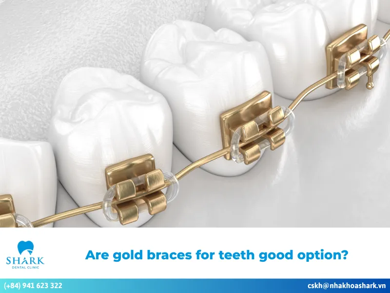Are gold braces for teeth good option?