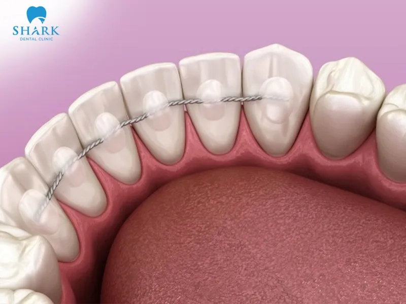 A fixed retainer provides high and long-term stability in maintaining tooth alignment