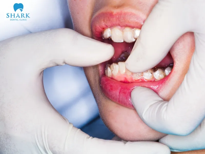 A retainer does not move the teeth but only helps stabilize their position on the dental arch