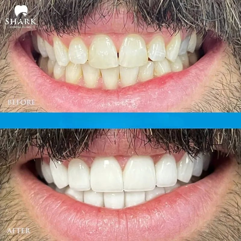 After veneer bonding, the teeth become more evenly aligned, with improved spacing and a brighter shade