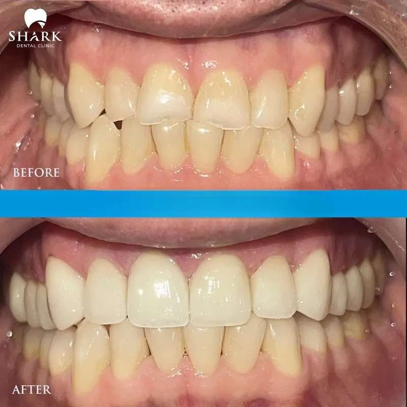 Porcelain veneers before and after images of a patient’s upper arch at Shark Dental Clinic clearly demonstrate the aesthetic improvement