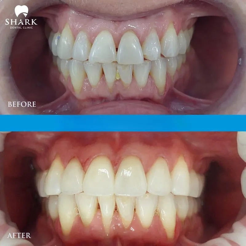 After veneer placement, the teeth appear whiter while still maintaining a natural and harmonious look