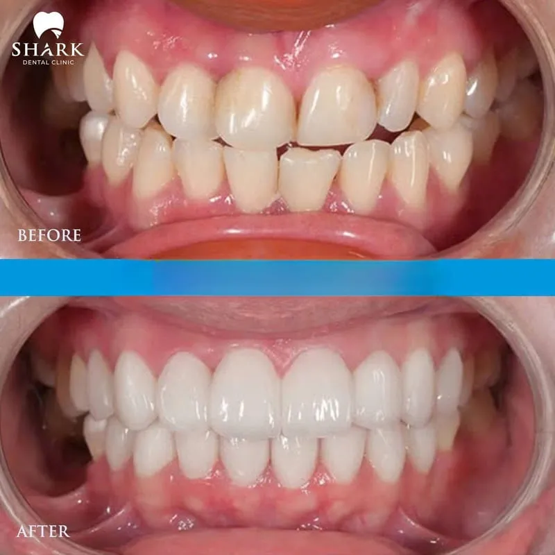 The difference in porcelain veneers before and after images is often very noticeable