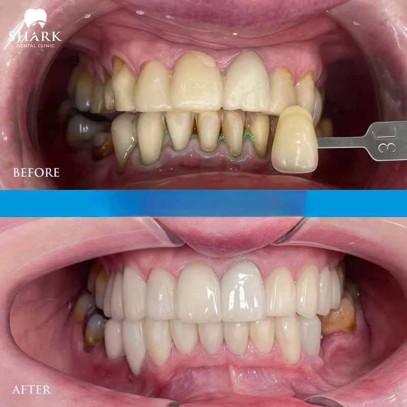 Porcelain veneers help adjust the shape of teeth, creating better balance and harmony for the entire dental arch