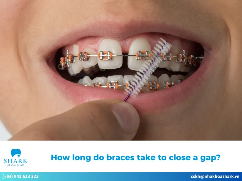 How long do braces take to close a gap