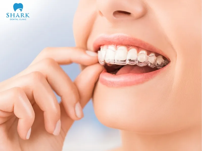 Invisalign applies advanced 3D technology, offering high precision and excellent aesthetics