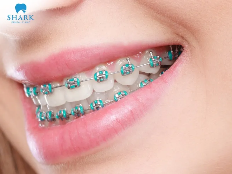 Conventional braces are appropriate for severe overbite, underbite, and significantly misaligned teeth