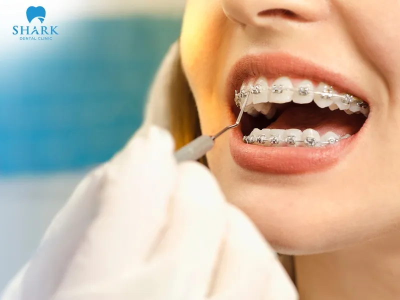 Traditional braces are more affordable and suitable for many people’s financial conditions