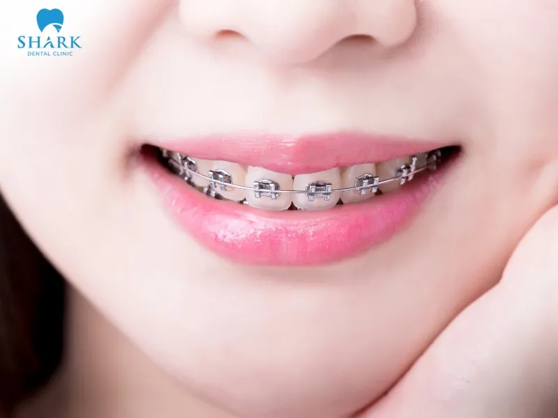 Invisalign treatment typically costs more than traditional braces