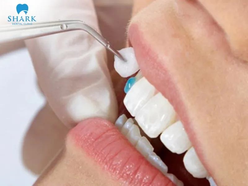 Dental adhesive is a dental material used to bond porcelain restorations to the natural tooth surface