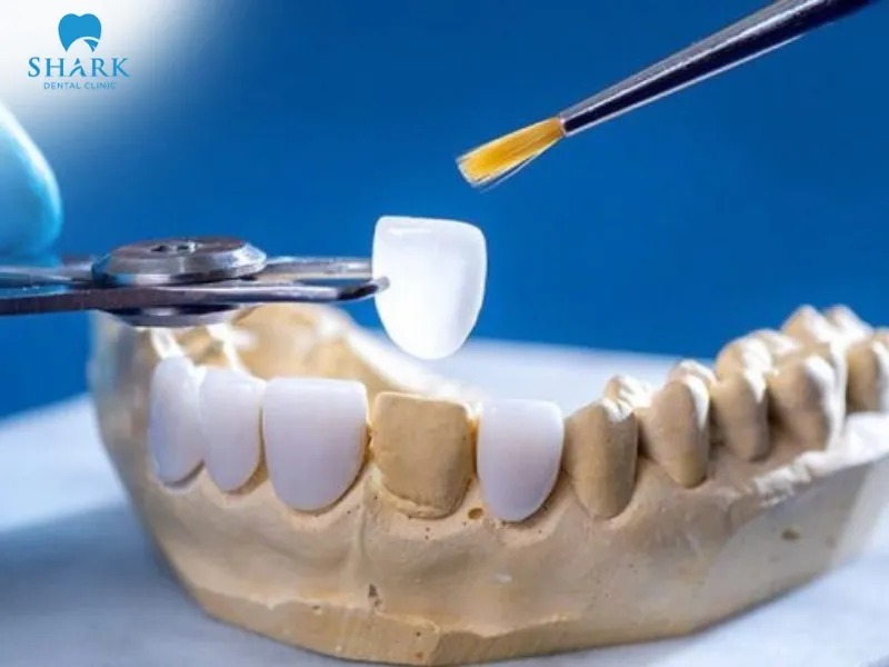 Dentists select dental adhesive based on the tooth position, color, and size of the porcelain veneer