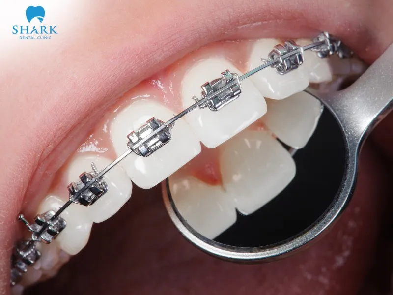 Traditional braces are suitable for cases of crooked teeth, overbite, and underbite ranging from mild to severe