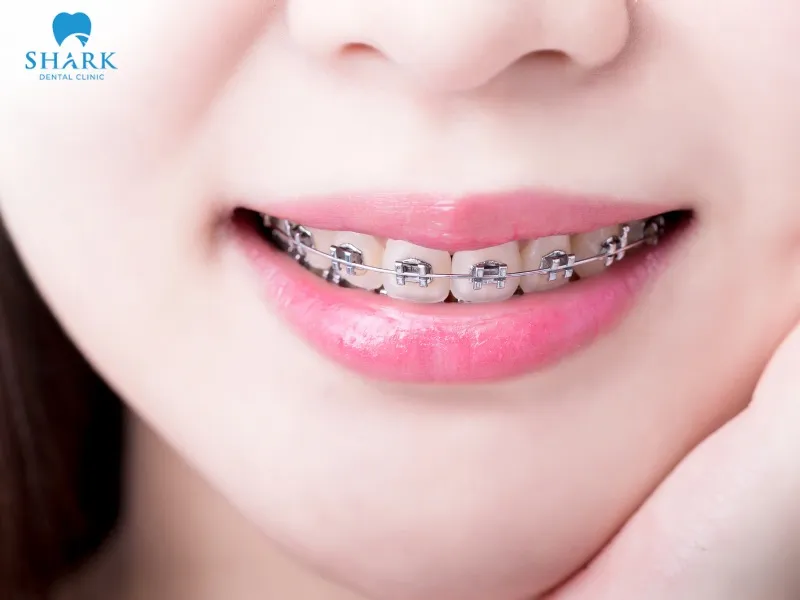 You need to attend regular follow-up appointments so the dentist can monitor the movement of your teeth in the oral cavity