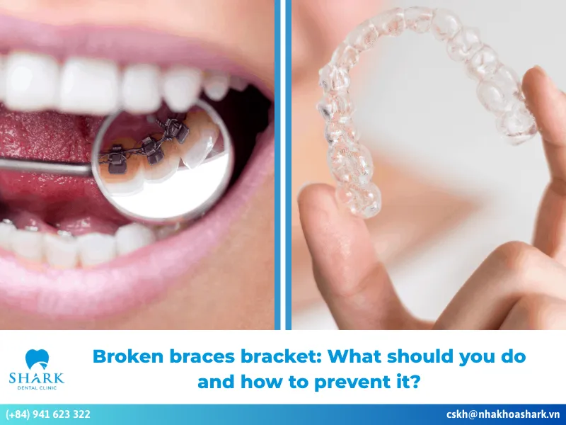 Lingual braces vs Invisalign