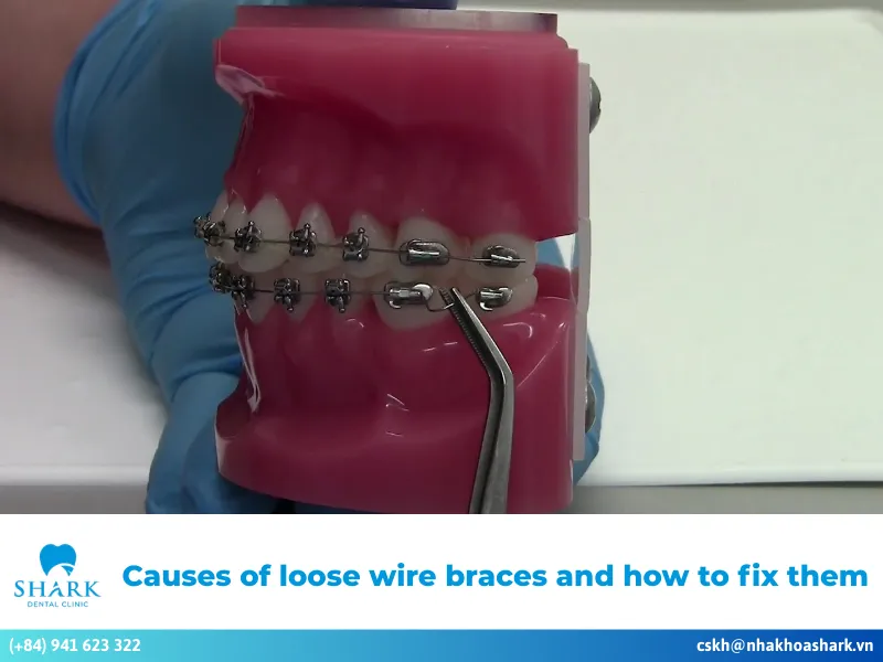 Causes of loose wire braces and how to fix them