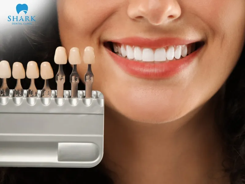 Porcelain veneers use thin shells made from high-quality ceramic materials