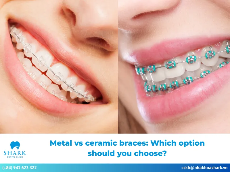 Metal vs ceramic braces: Which option should you choose?