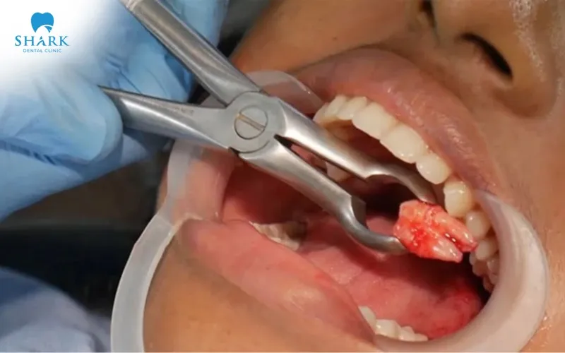 Within the first 24 hours after extraction, you may experience pain and mild swelling around the recently removed tooth area